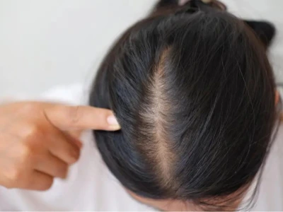 Hair Patch Service in Indore