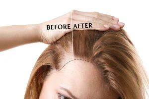 Best Hair Clinic in Indore