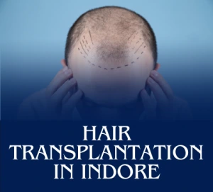 Hair Transplantation in Indore