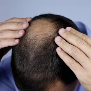 hair loss treatment