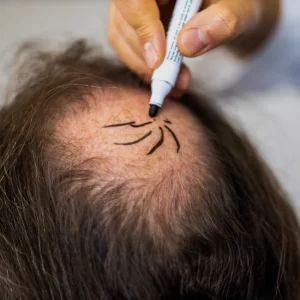 Hair Transplantation