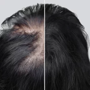 hair patch in indore