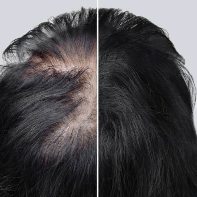 hair patch in indore