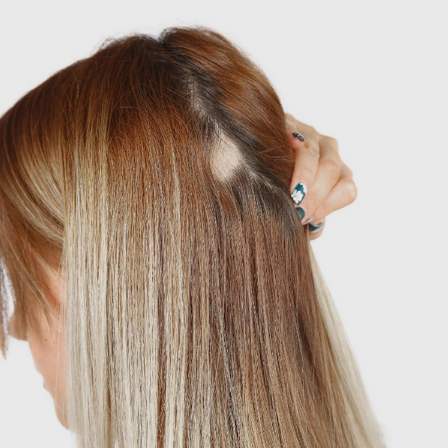 Best Alopecia Treatment in Indore