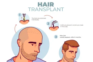 hair transplantation in Indore