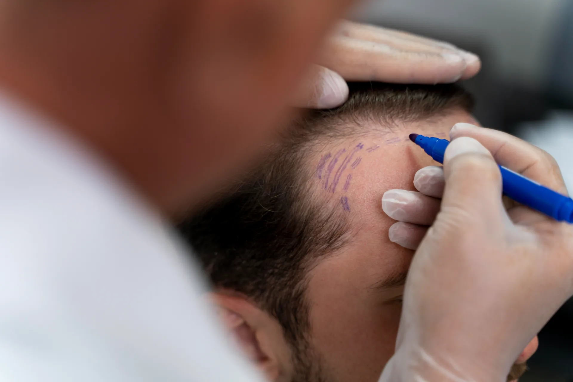 Best Hair patch in Indore