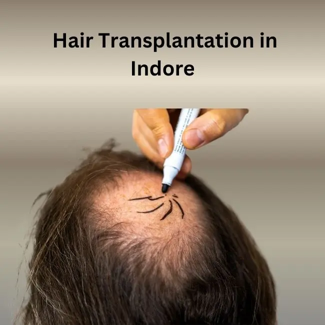 Hair Transplantation in Indore