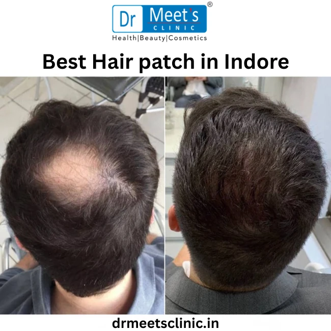 Best Hair patch in Indore
