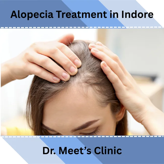 alopecia treatment in Indore