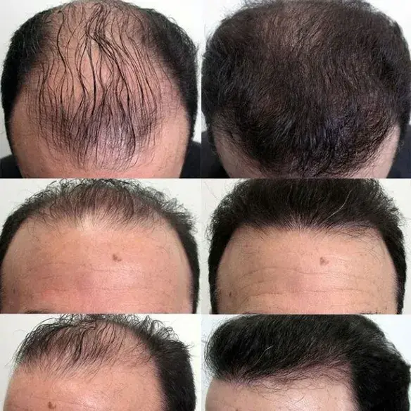 hair transplantation in Indore